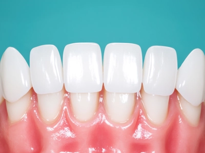 治療法1｜セラミック矯正