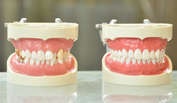 セラミック矯正とは【画像】