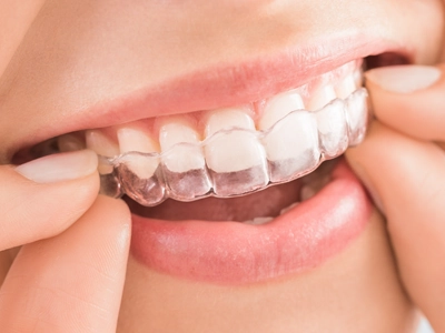 治療法3｜マウスピース矯正