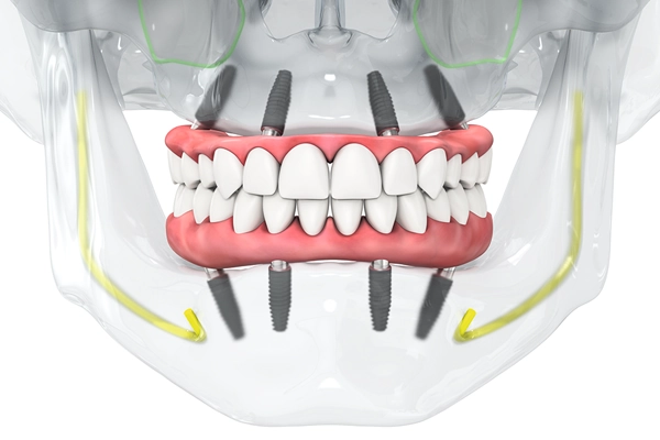 オールオン4【画像】