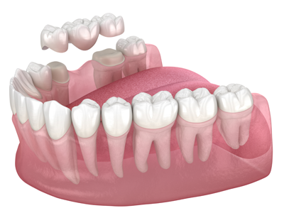 治療法2｜ブリッジ