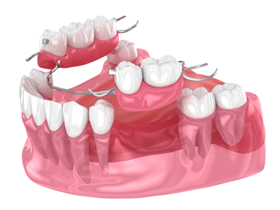 治療法3｜部分入れ歯