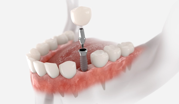 インプラント治療