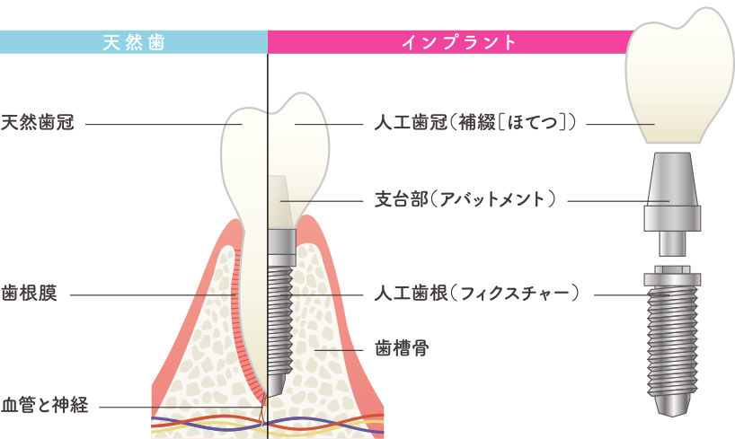 インプラント構造図と歯の構造図