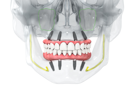 Straumann®ストローマン｜オールオン4インプラント【画像】