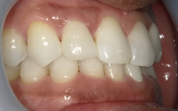 症例0926ラミネートべニア【治療後】