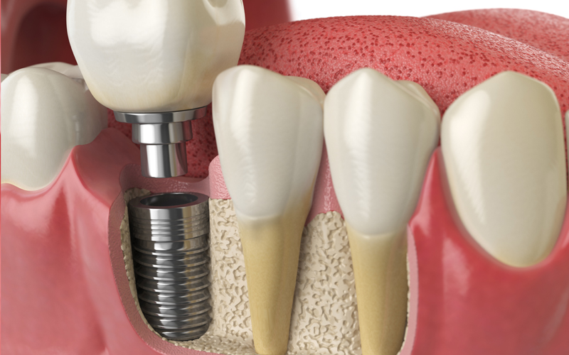 インプラントの歯の寿命はどのくらい？老後まで持つ？長持ちさせる方法を解説！