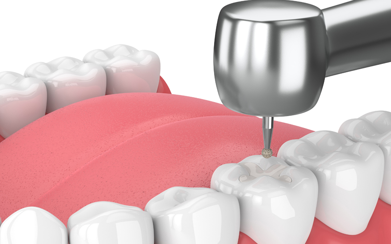 歯を削る量は治療方法によって異なる